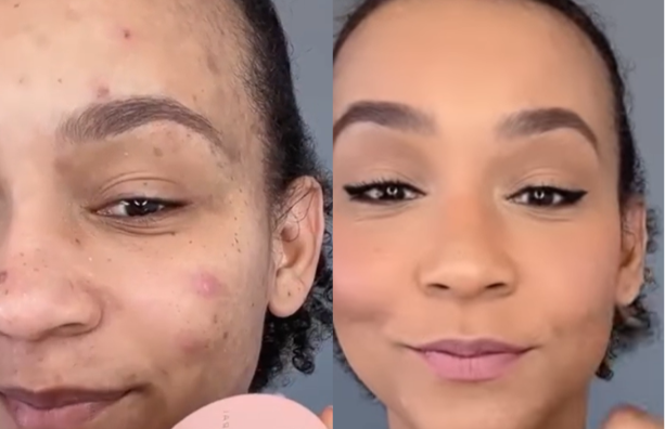 Effective Coverage For Acne